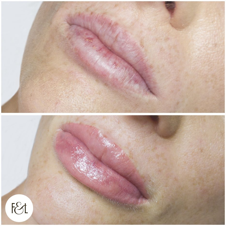 Mel Lips B&A